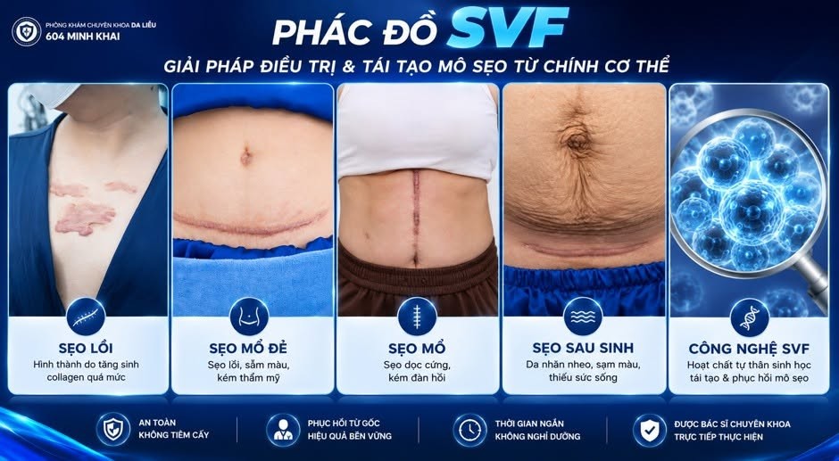 cong-nghe-cay-hoat-chat-tu-than-svf-2-1783079431.jpg