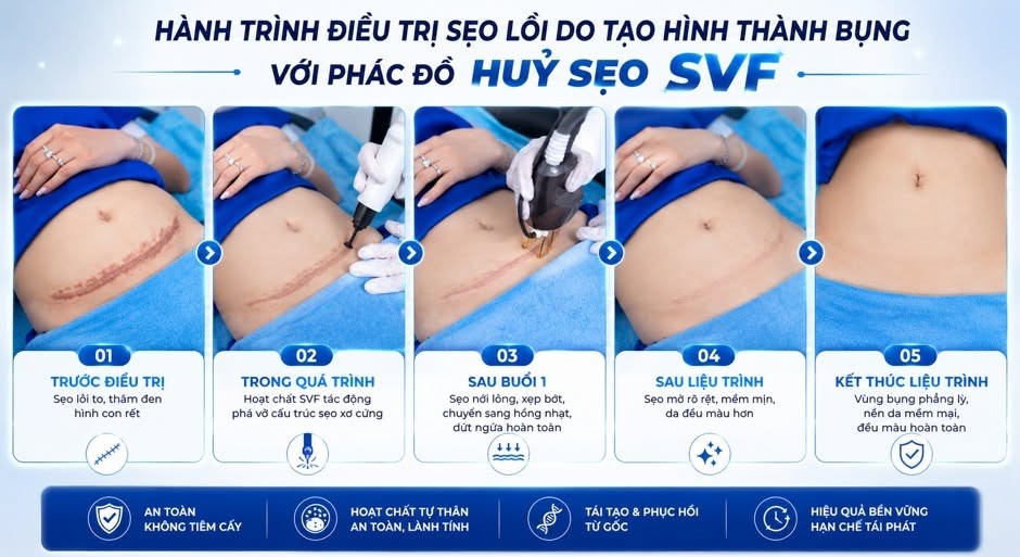cong-nghe-cay-hoat-chat-tu-than-svf-4-1783079431.jpg